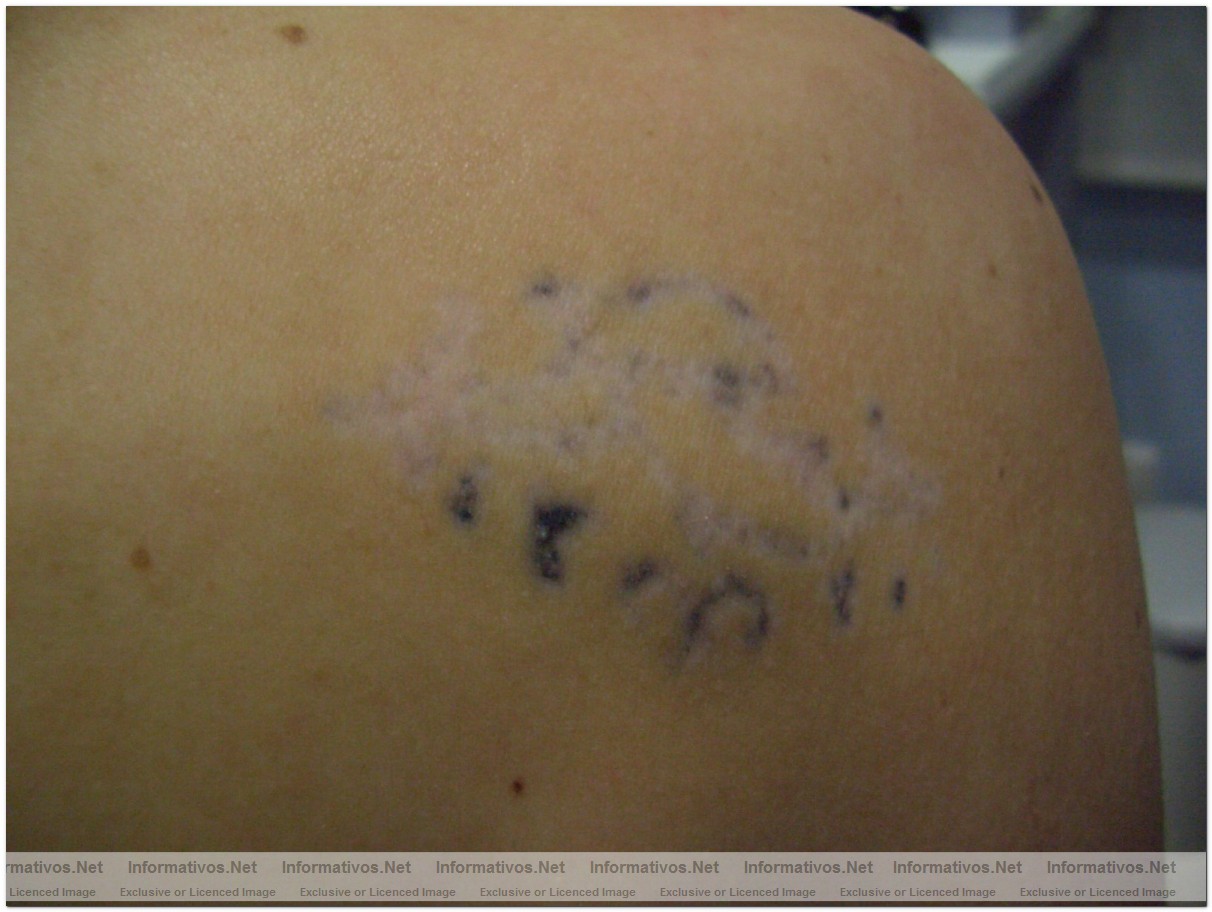 El l�ser permite eliminar tatuajes por sistema linf�tico: tatoo tras 5 sesiones