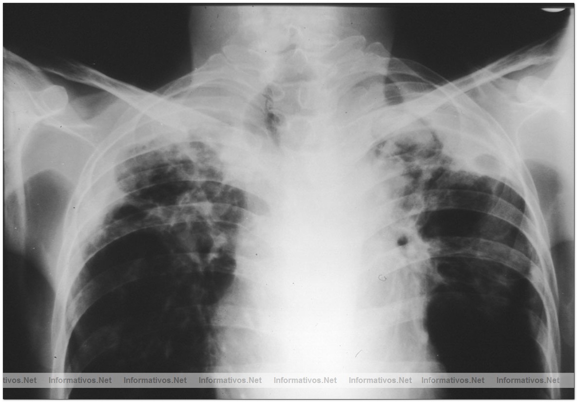 Barcelona forma parte de una investigaci�n mundial contra la Tuberculosis, una enfermedad que afecta por lo general a los pulmones. La tuberculosis compromete otras partes del cuerpo, como el cerebro, los ri�ones o la columna vertebral. Si no se trata, la TB puede causar la muerte.
